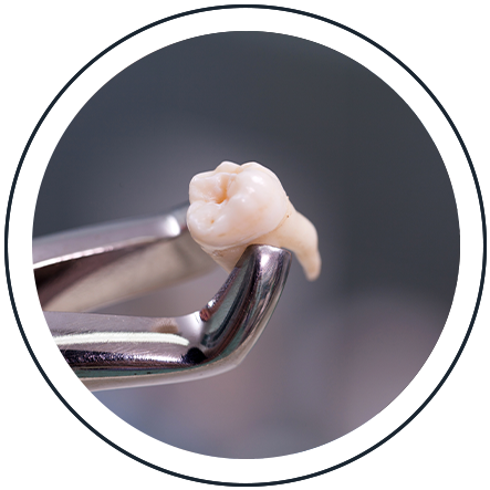 Dental forceps holding an extracted tooth