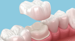 Illustration of a dental crown being fitted onto a tooth