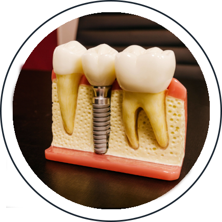 Patient with a restored smile from dental implants at Deerfoot Dental Centre in Calgary